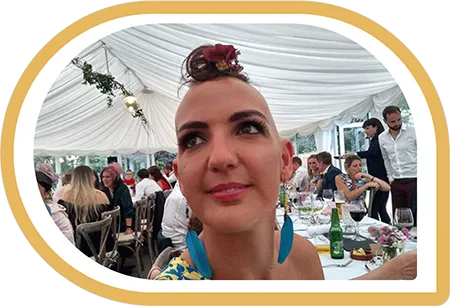 Lady-Alopecia-in-Ireland