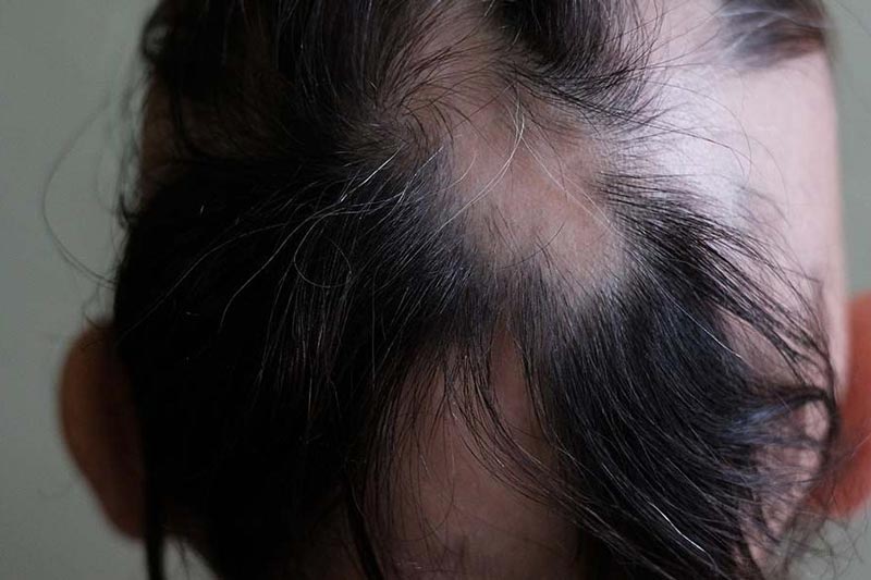 Emma's head with white hairs