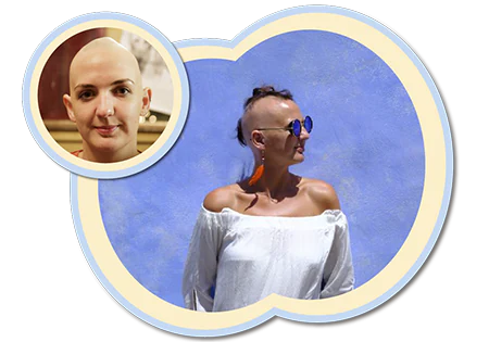 Girl with bald alopecia head