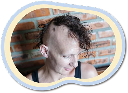 Girl with alopecia areata