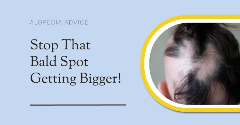 How to Stop Alopecia Areata from Spreading