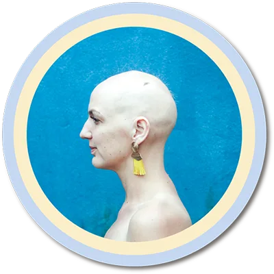 lady alopecia bald girl